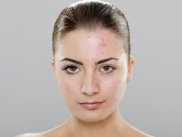 Girl Before Acne Chemical Peel Treatment by Dermatologist