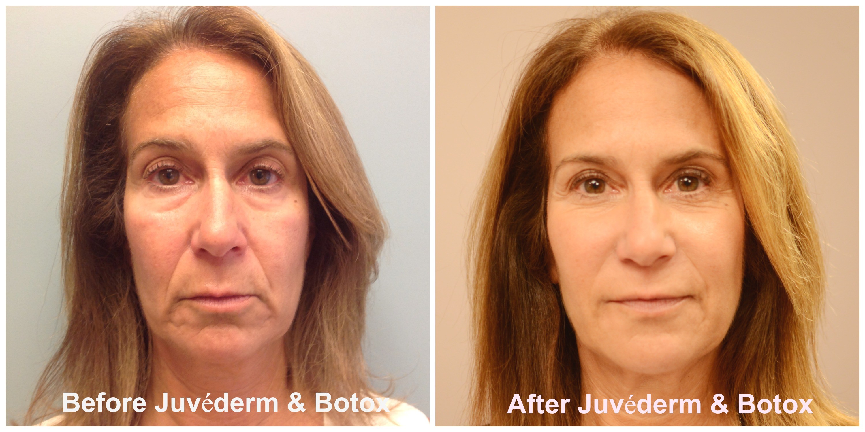 Juvederm