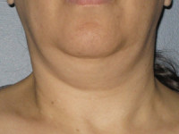 Ultherapy Skin Tightening Before & After