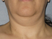 How to lose turkey neck 2025 fat