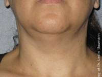 Ultherapy Skin Tightening Before & After 2