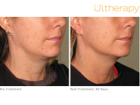 How Does Ultherapy Work