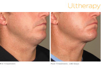 Ultherapy For Men