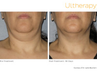 Ultherapy for Turkey Neck Before and After Pictures
