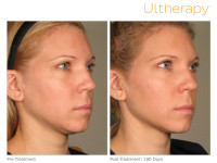 Ultherapy In Maryland