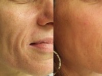 Dermal Filler Special