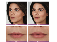 Juvederm Volbella Before and After photos