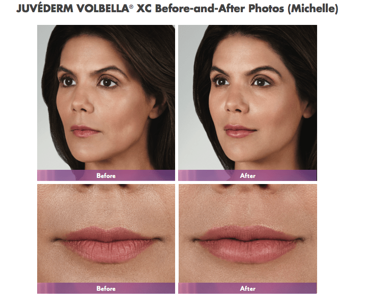 We are Now Offering Juvederm’s Newest Product Volbella! Chevy Chase