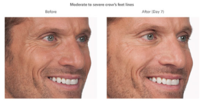 człowiek Botox przed i po