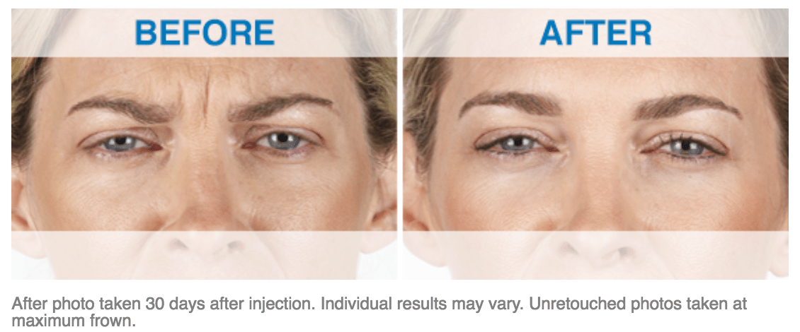 Xeomin Treatment Before and After Photos 