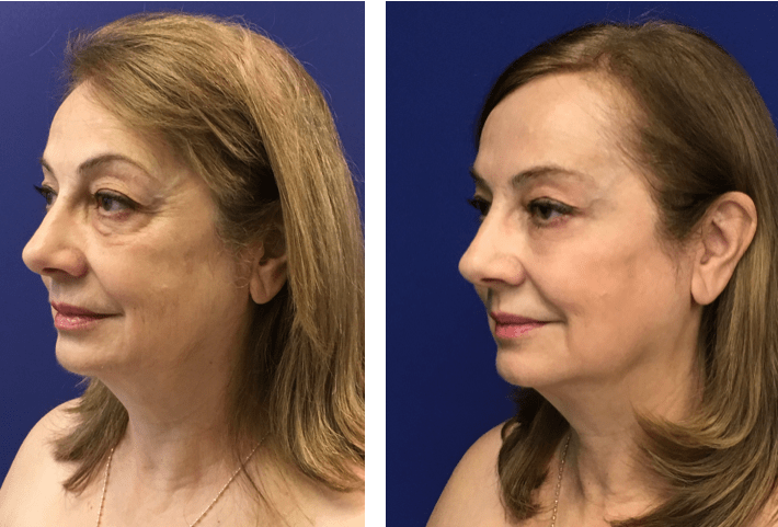 Ultherapy Before and After Pictures Chevy Chase Cosmetic Center