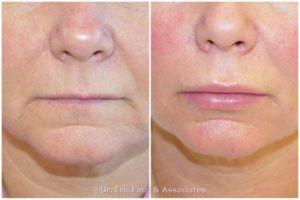 Lips Fat Transfer Before and After Photo