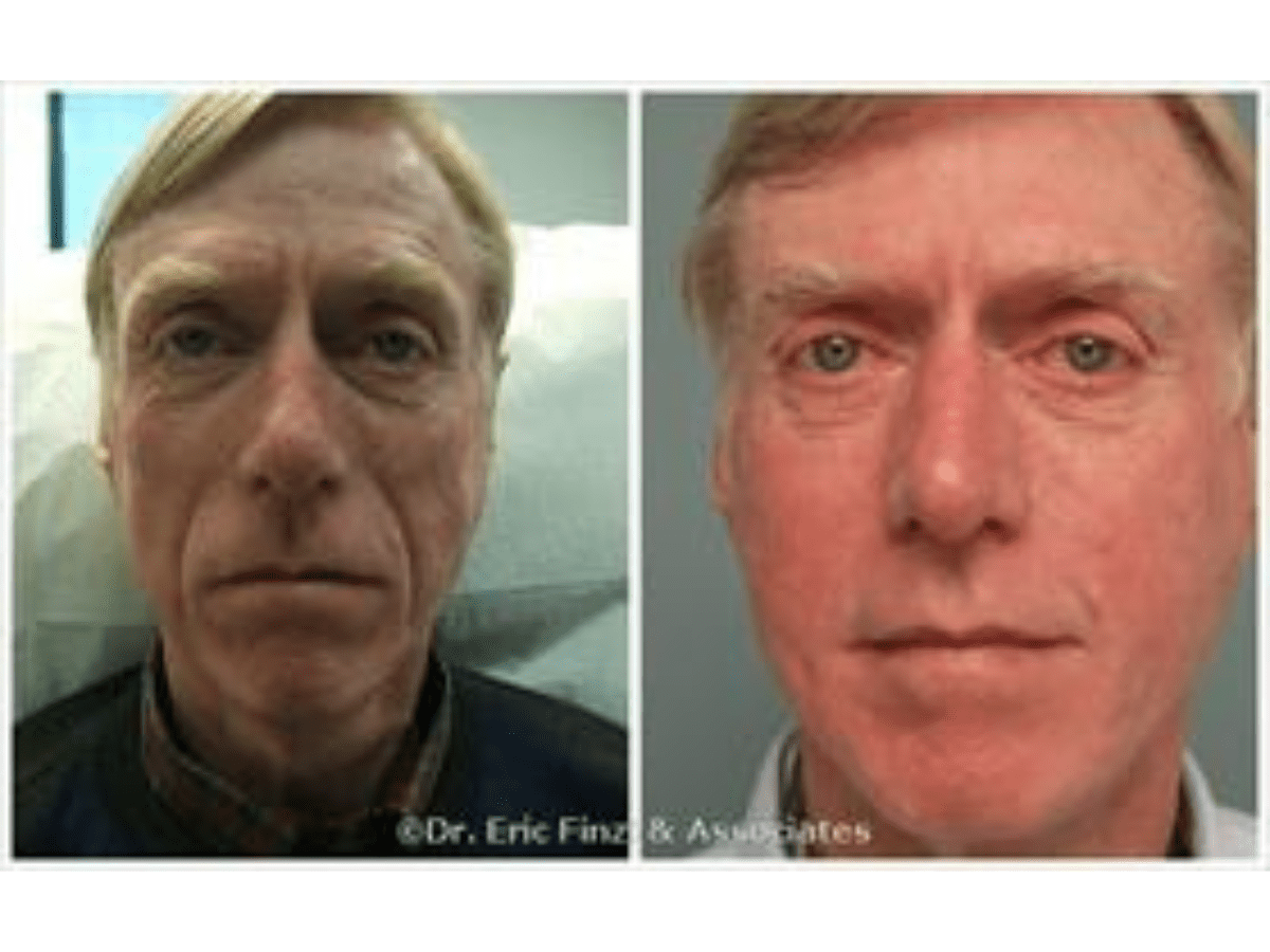 before and after injectable