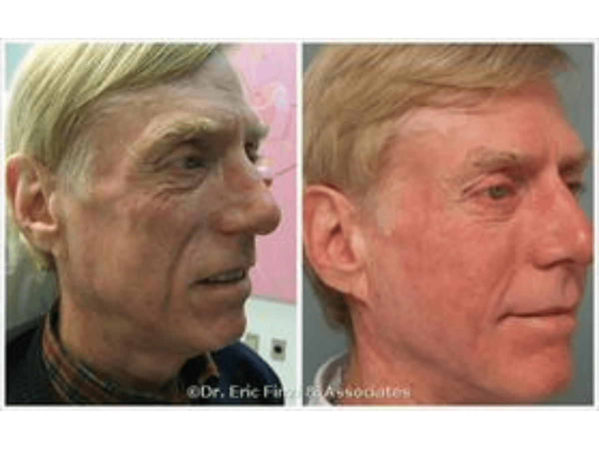 before and after injectable
