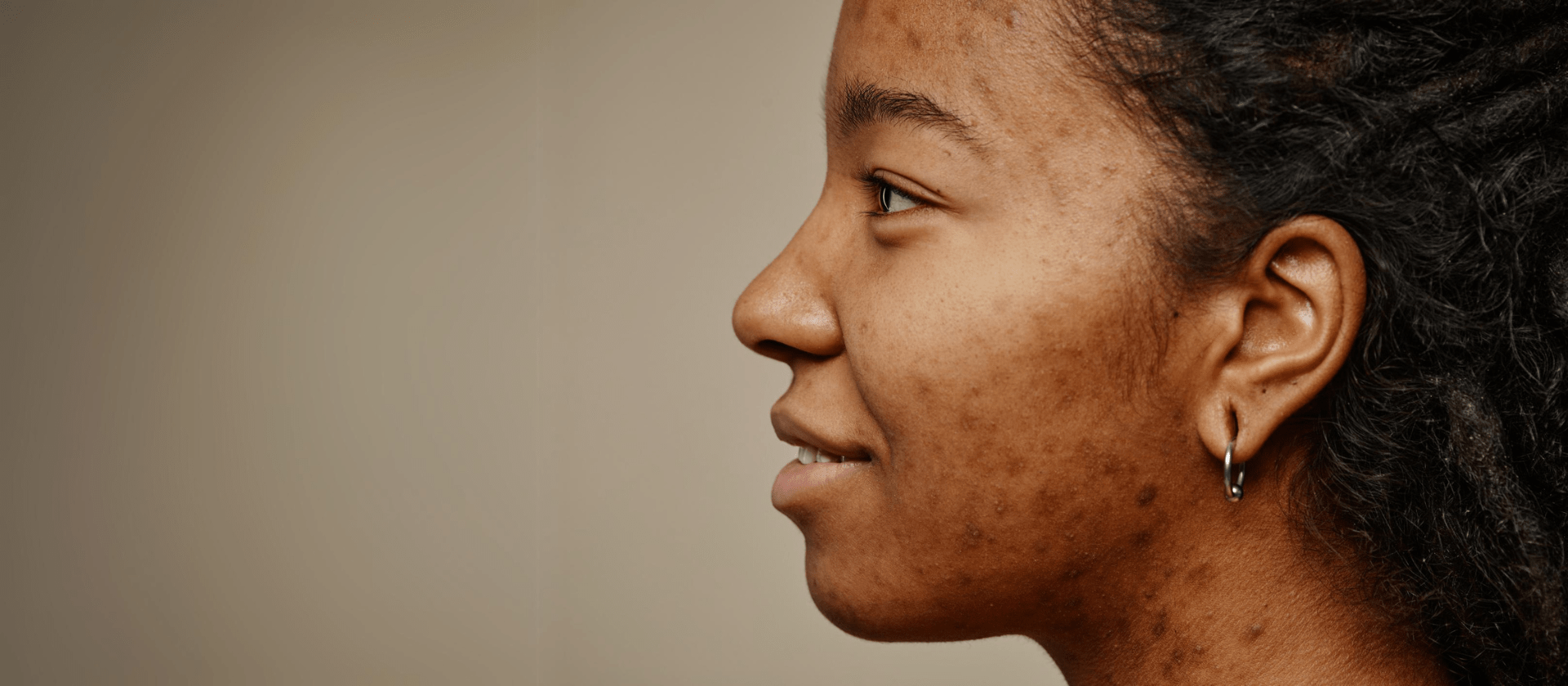 African American woman with acne