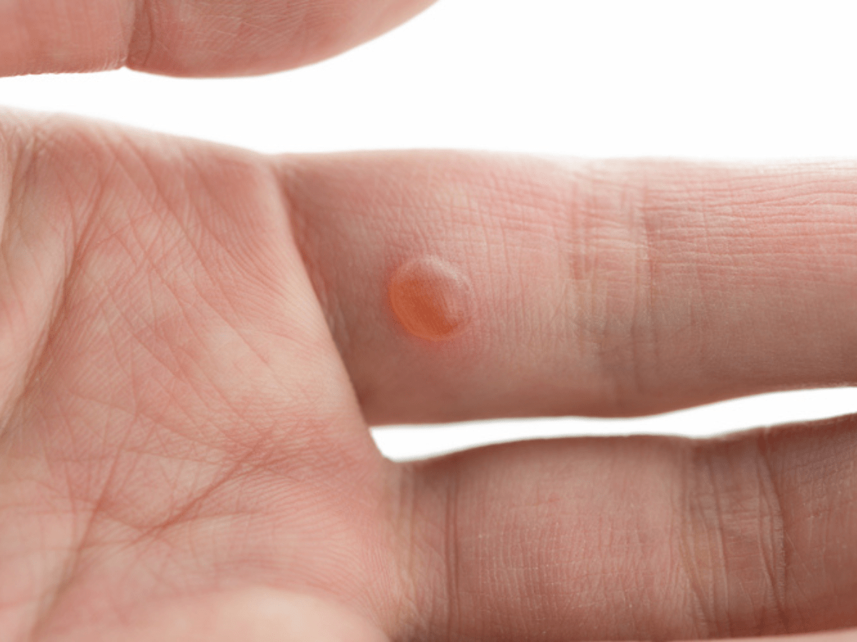 A finger with a wart