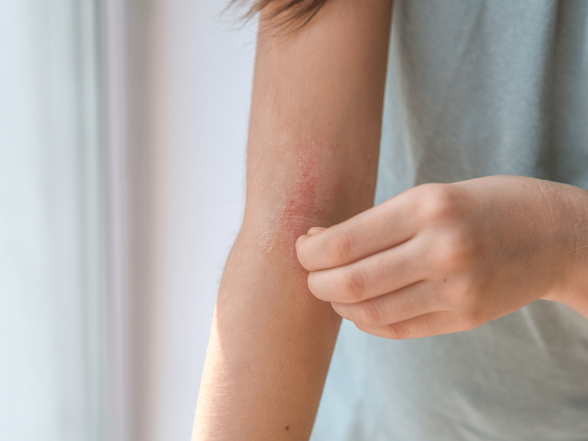 eczema on arm