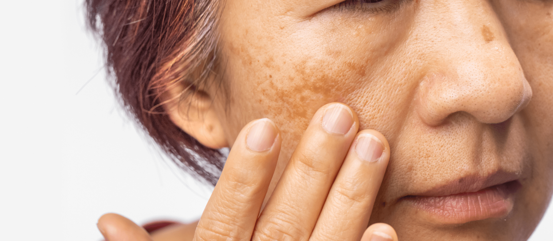 melasma on a woman's face