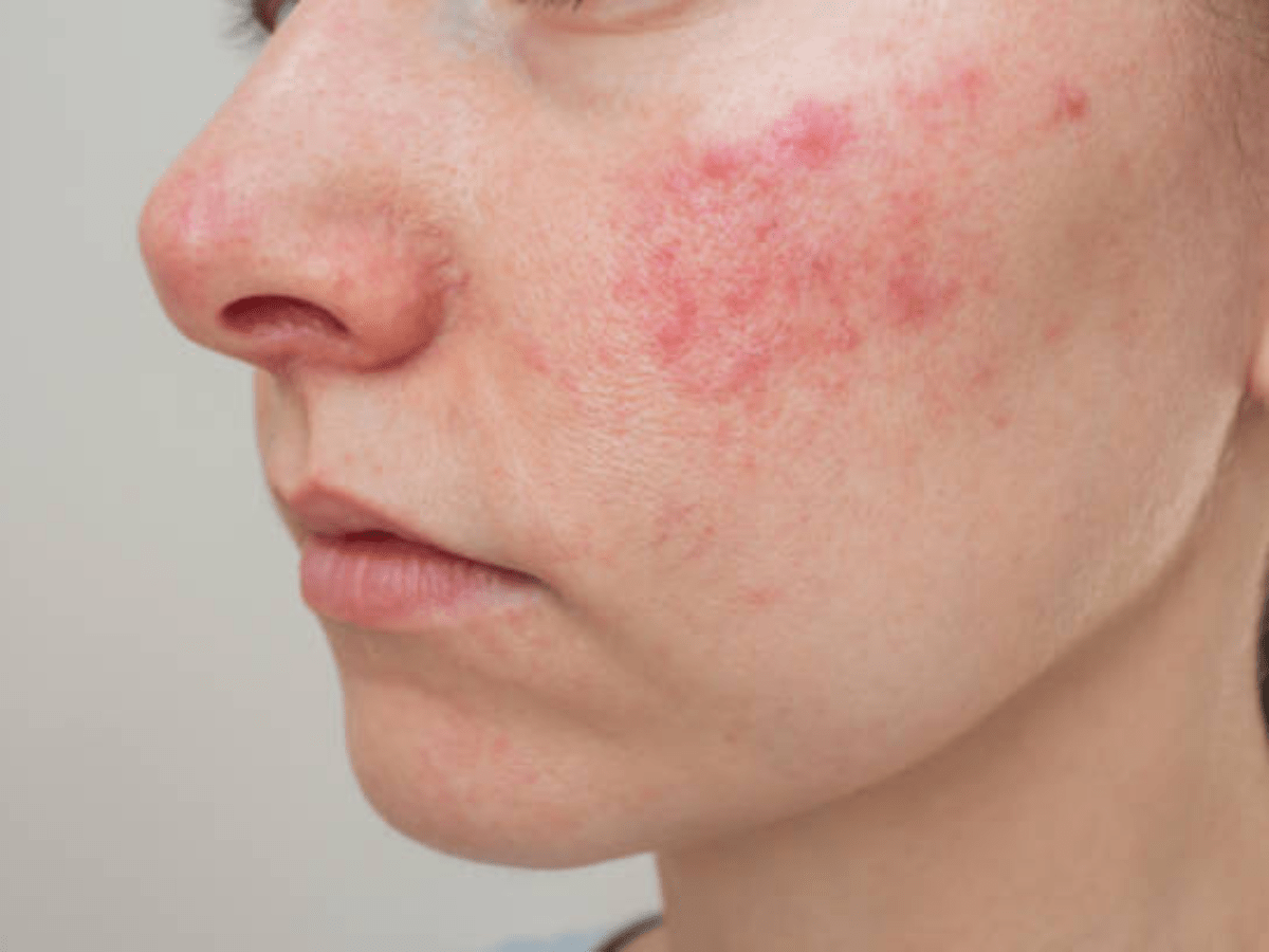 a girl dealing with rosacea